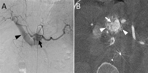 -(A) Angiography of the celiac trunk, showing mass-like enhancement... | Download Scientific Diagram