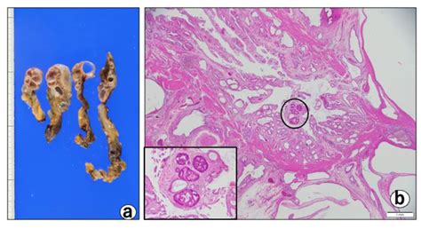 Diagnostics | Free Full-Text | A Case of Early-Stage Gallbladder Cancer ...