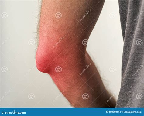 Man with Painful Elbow or with Inflammation Stock Photo - Image of ...