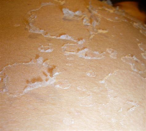 File:Skin peeling.jpg - Wikimedia Commons