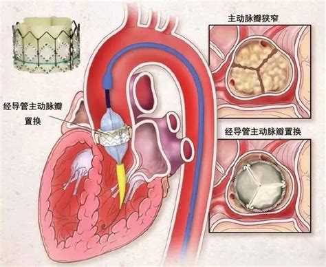 心脏手术不开胸 七旬伯伯这样“换门”重获“心”生-台州频道