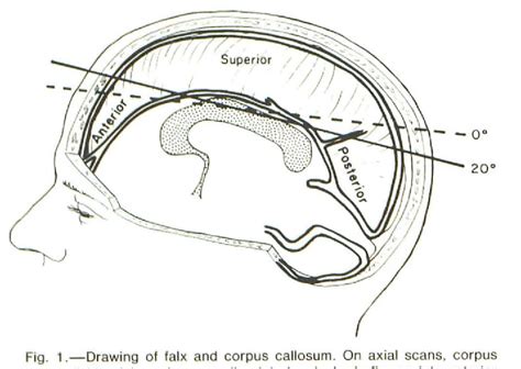 [PDF] Falx and interhemispheric fissure on axial CT: I. Normal anatomy. | Semantic Scholar