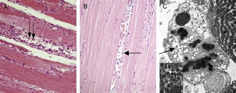 Muscle biopsy specimens. (A) The muscle biopsy specimen from Case 1 ...