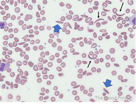 Sickle Cells • The Blood Project