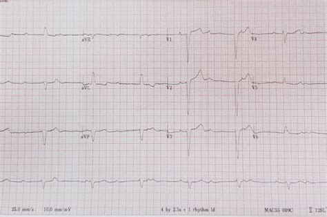 Third Degree Heart Block | Causes, Symptoms, and Treatment Options