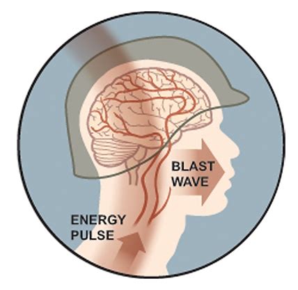 The Mechanics of a Blast Injury | BrainLine