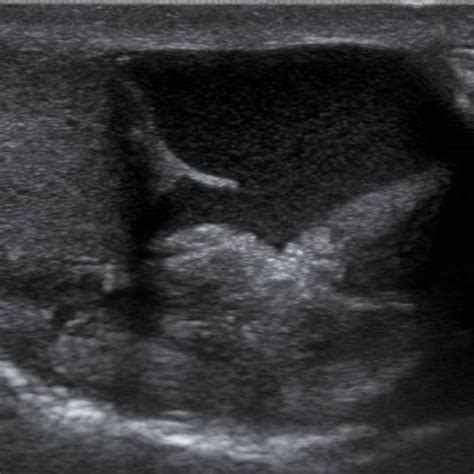 Varicocele demonstrated in (a) Grayscale and (b) Color Doppler ...