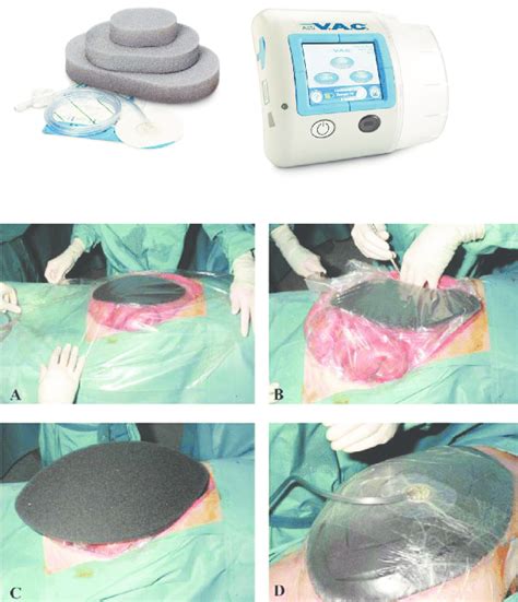 Prospective evaluation of vacuum-assisted closure in abdominal... | Download Scientific Diagram