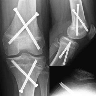 (PDF) Comparison of three surgical epiphysiodesis techniques for the treatment of lower limb ...