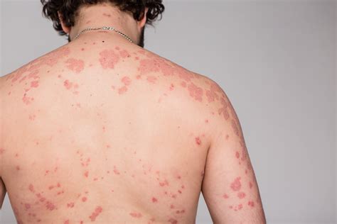 What Is Psoriasis? | Fatty Liver Disease