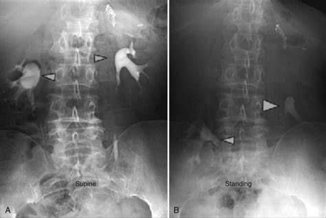 Laparoscopic Surgery of the Kidney | Abdominal Key