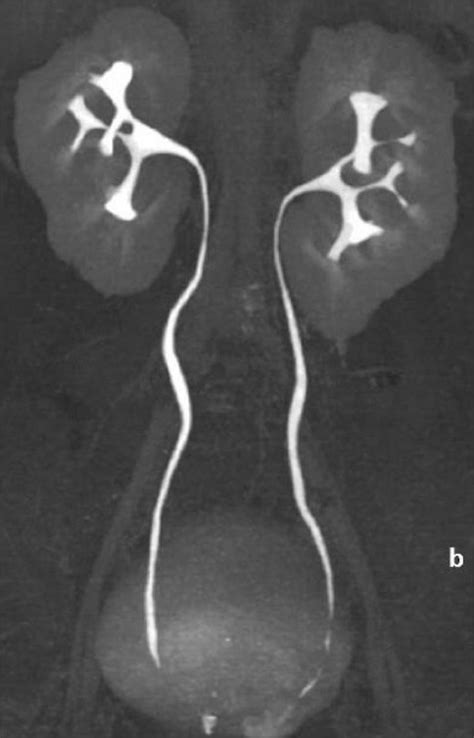 CT urogram. A maximum intensity projection, coronal CT | Open-i