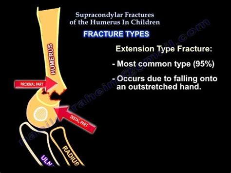 Supracondylar Humerus Fracture