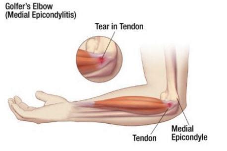 Medial Epicondylitis - Treatment, Exercises, Causes, Symptoms