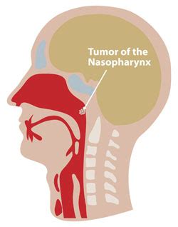 Diagnosing tumours in the nasopharynx without surgery