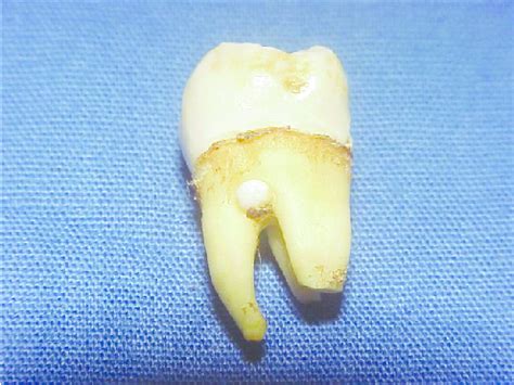 What is ectopic enamel | News | Dentagama