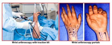 Wrist Arthroscopy – Home | Consultant Orthopaedic Surgeon