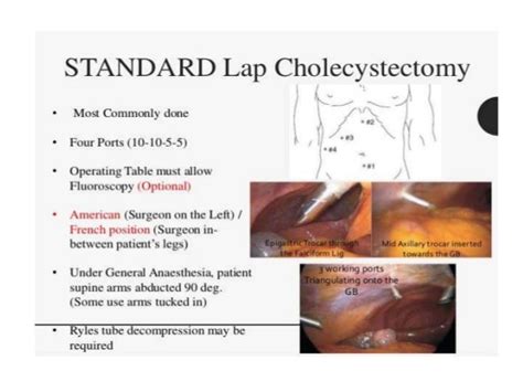 Complications of laparoscopic cholecystectomy, by Dr. Bashab Bijoy Ro…