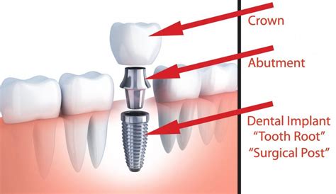 Dental Implants Frisco, TX, Dr. Mark Davis