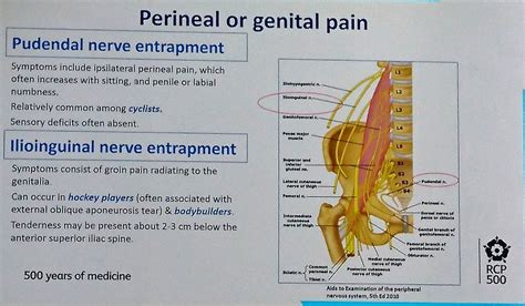 Ilioinguinal Nerve Entrapment