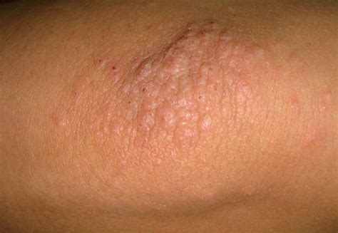 Dermatitis on elbow pictures | Symptoms and pictures