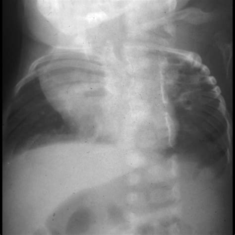 Pulmonary Hypoplasia | Pediatric Radiology Reference Article | Pediatric Imaging | @pedsimaging