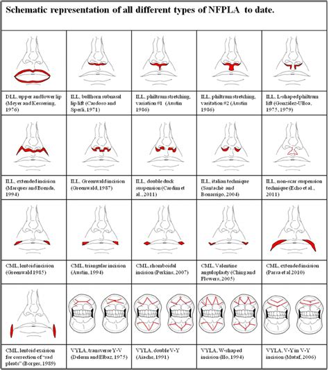 Red compact lines: line of incision. Each type of VYLA surgery includes... | Download Scientific ...