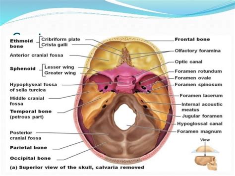 Sphenoid wing meningioma