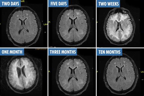 Scans reveal how cocaine ‘eats away’ at your brain in a matter of months – The Irish Sun