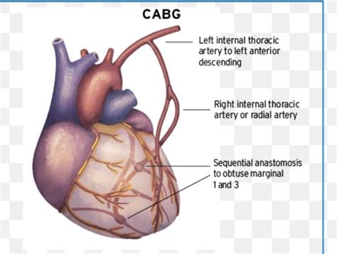 Alchemist Hospital: Alchemist cardiac surgeons using LIMA RIMA-Y technique for bypass surgery