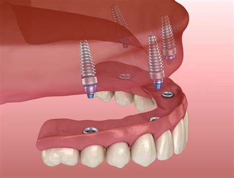 Implant Supported Dentures - Smith and Cole Dentistry