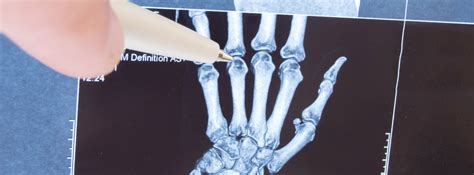 Rheumatoid Arthritis Surgery - Orlando Hand Surgery Specialists | Wrist Surgery