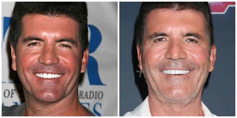 Simon Cowell Teeth: What's Wrong With His Blindingly Pearly Whites?