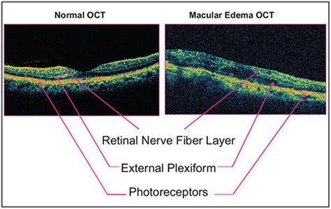 Macular Edema Oct