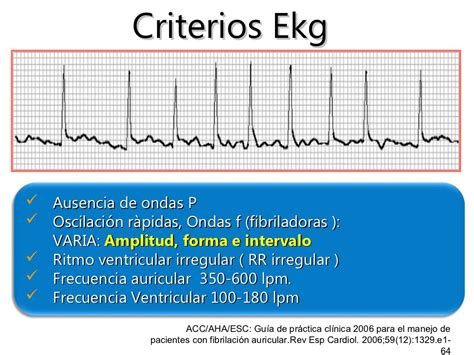 Fibrilación auricular