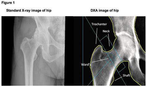 Dexalytics News // Standard X-Ray VS. Dual X-Ray Absorptiometry (DXA)