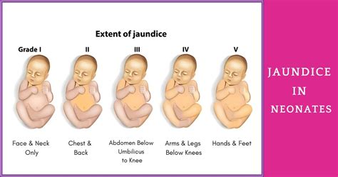 Bacaan Kuning Bayi: Simptom, Risiko & Rawatan Yang Disarankan