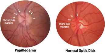 Papilloedema - www.medicoapps.org