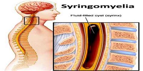 Syringomyelia - Assignment Point