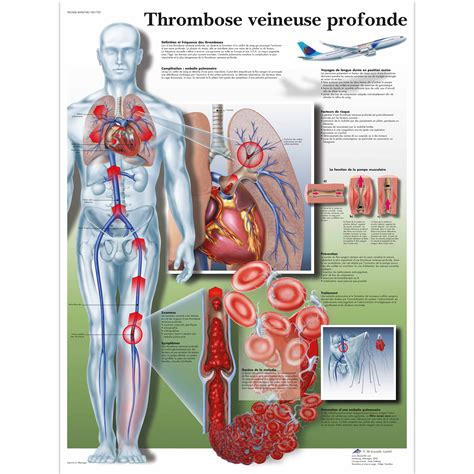 Thrombose veineuse profonde - 4006768 - VR2368UU - système cardiovasculaire - 3B Scientific