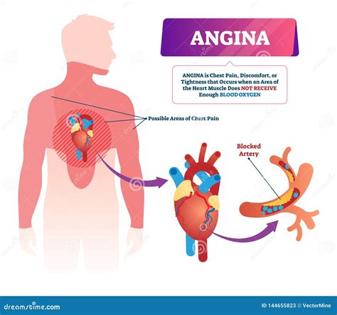 Angina Vector Illustration. Labeled Medical Chest Pain and Heart ...