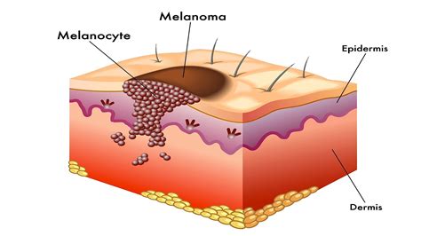 Connection between Viagra and Skin Cancer | Canadian Pharmacy Mall