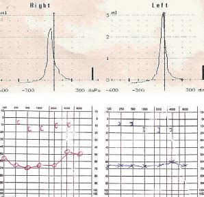 Tympanogram and audiogram (case 2). | Download Scientific Diagram