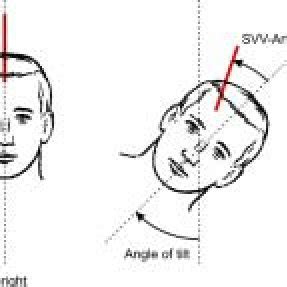 (PDF) Unilateral examination of utricle and saccule function