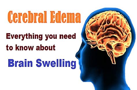 Cerebral Edema (Brain Swelling) - Types, Symptoms, Causes and Treatment