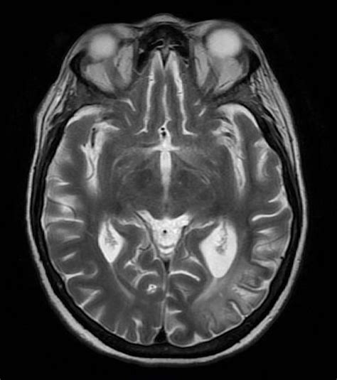 CMV encephalitis in an immune-competent patient | BMJ Case Reports