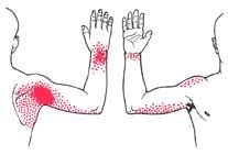 Symptoms of Frozen Shoulder