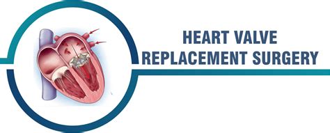 Heart Valve Replacement Surgery | Global Care