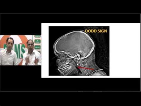 Juvenile Nasopharyngeal Angiofibroma: Integrated Approach - Sumer's Radiology Blog