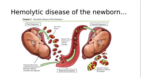 Hemolytic Disease | Medical ultrasound, Medical knowledge, Neonatology